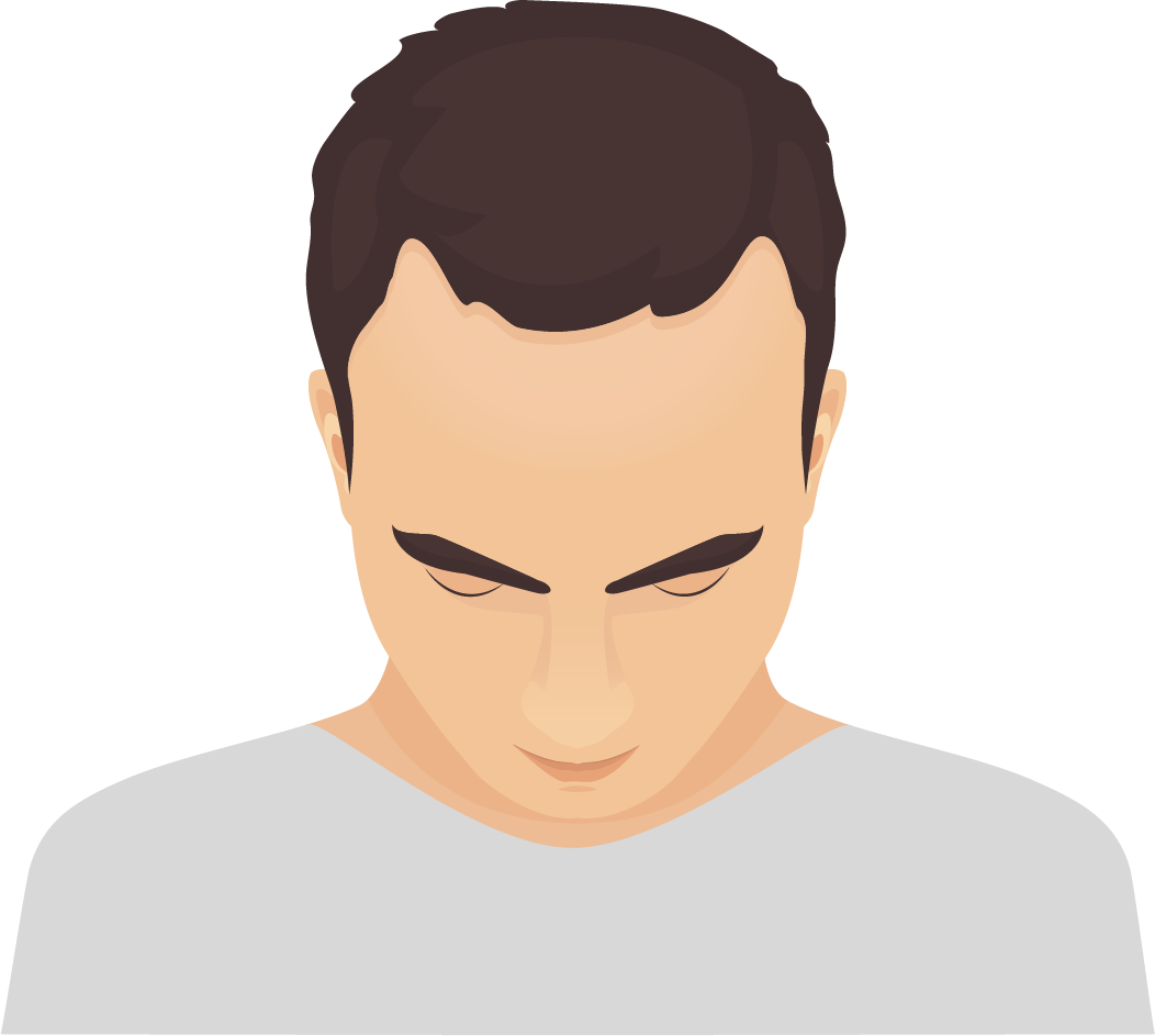 Diffuse alopecia