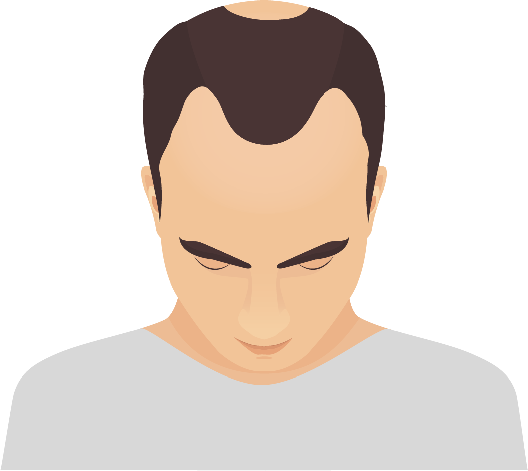 Alopecia areata